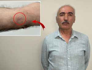 Kolundaki 1 santimetrelik yara kanser çıktı
