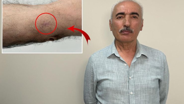 Kolundaki 1 santimetrelik yara kanser çıktı